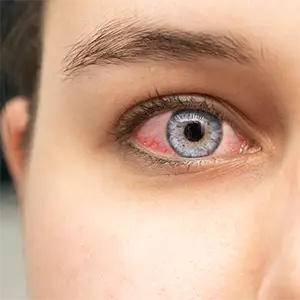 Auge mit blauer Iris und Rötung um die Augenpartie